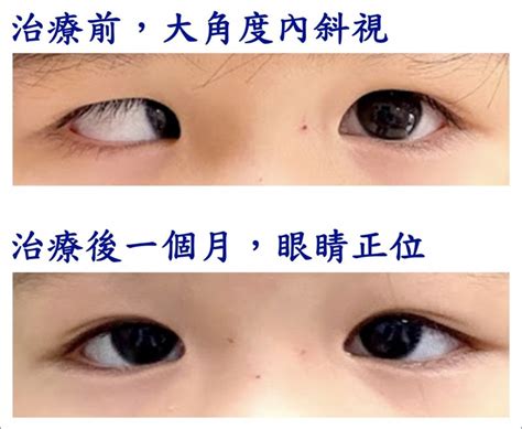 幼兒斜眼看人|了解嬰幼兒斜視原因及治療方法